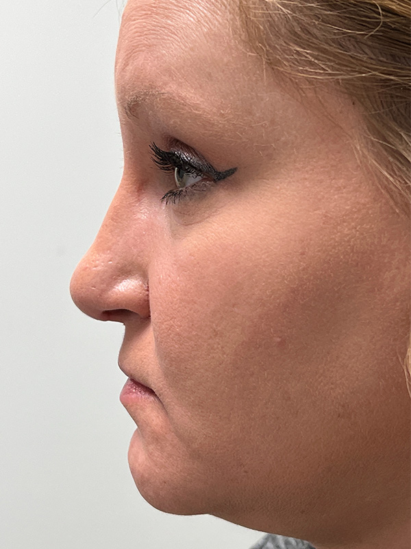 Rhinoplasty Before and After | Rashid Plastic Surgery