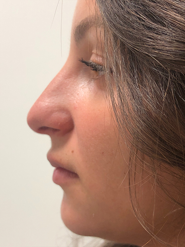 Rhinoplasty Before and After | Rashid Plastic Surgery