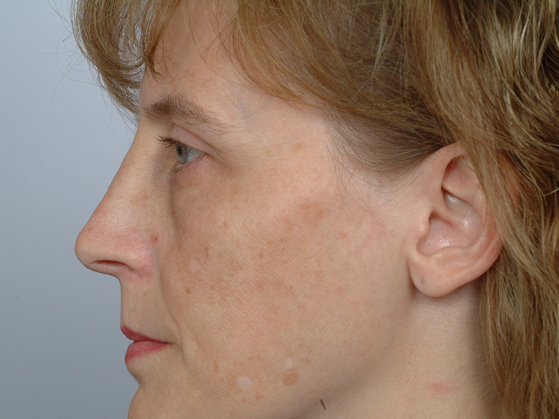 Rhinoplasty Before and After | Rashid Plastic Surgery