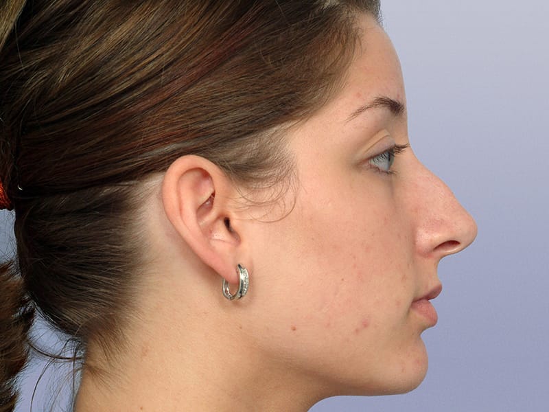 Rhinoplasty Before and After | Rashid Plastic Surgery