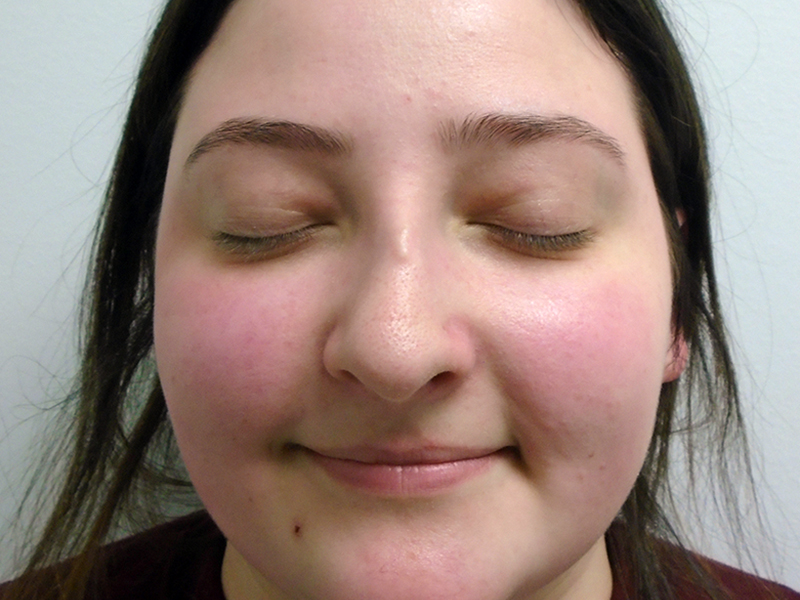 Rhinoplasty Before and After | Rashid Plastic Surgery