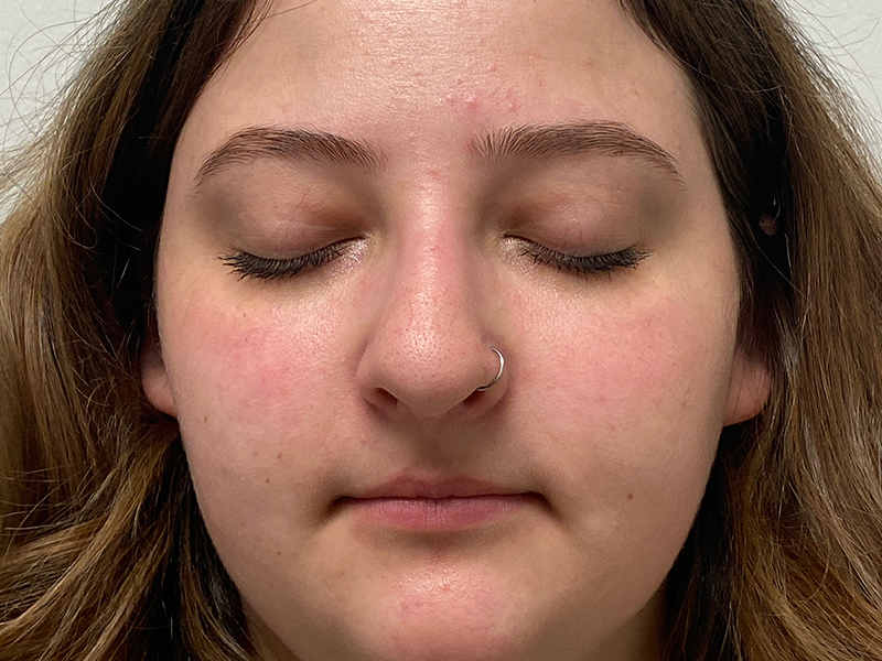 Rhinoplasty Before and After | Rashid Plastic Surgery