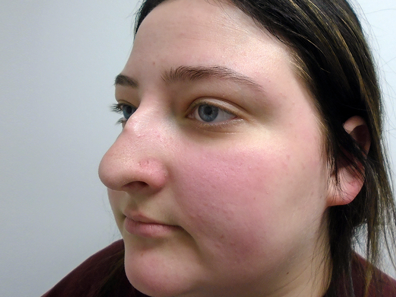 Rhinoplasty Before and After | Rashid Plastic Surgery