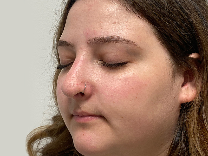 Rhinoplasty Before and After | Rashid Plastic Surgery
