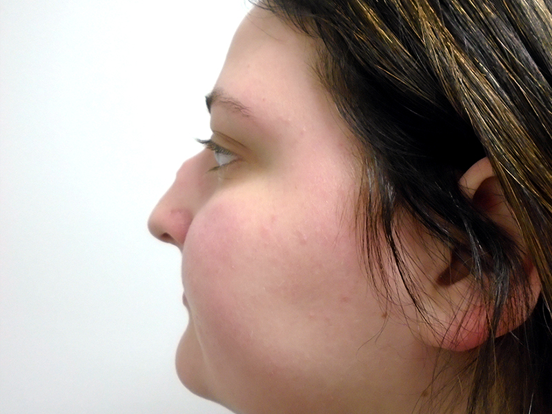 Rhinoplasty Before and After | Rashid Plastic Surgery
