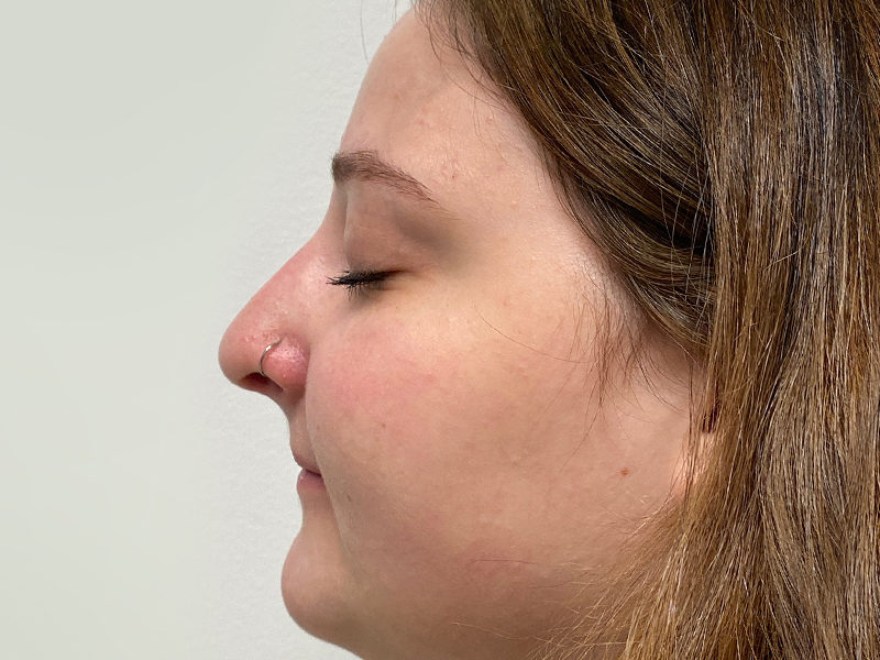 Rhinoplasty Before and After | Rashid Plastic Surgery