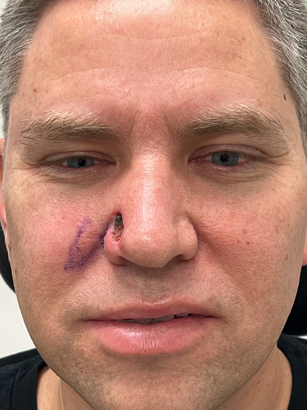 Skin Cancer Removal Before and After | Rashid Plastic Surgery