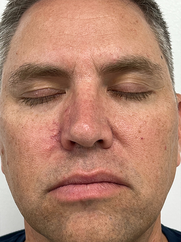 Skin Cancer Removal Before and After | Rashid Plastic Surgery