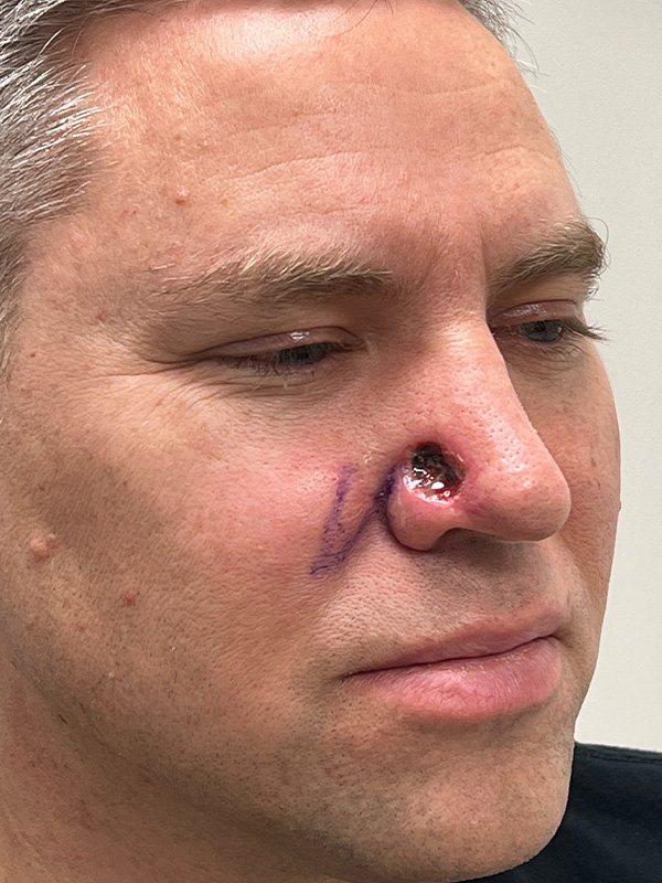 Skin Cancer Removal Before and After | Rashid Plastic Surgery