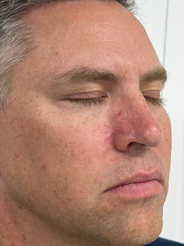 Skin Cancer Removal Before and After | Rashid Plastic Surgery