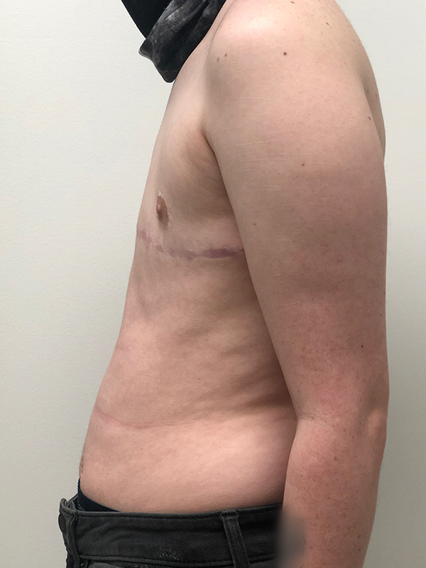 Top Surgery Before and After | Rashid Plastic Surgery