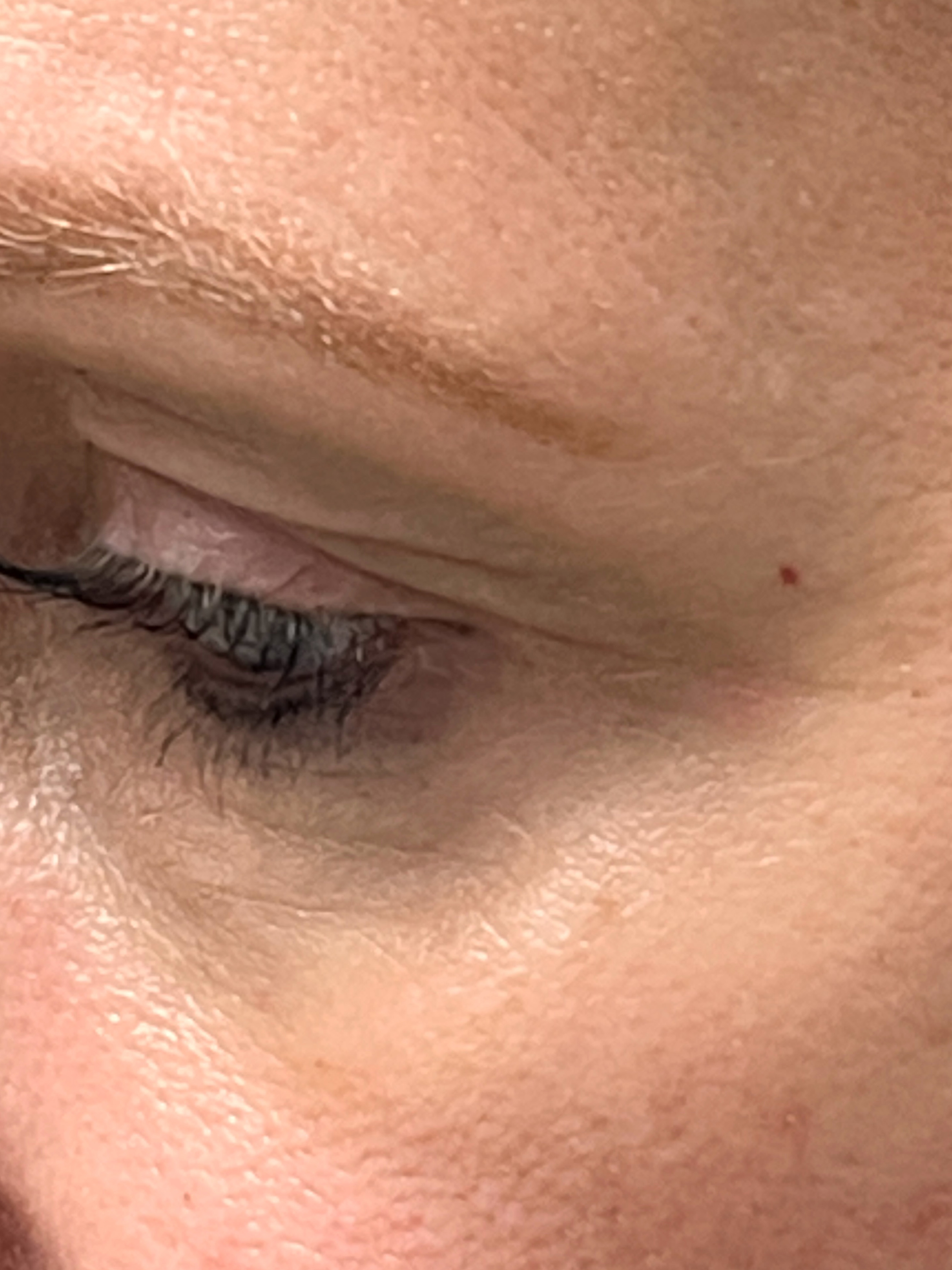 Vascular Laser Before and After | Rashid Plastic Surgery