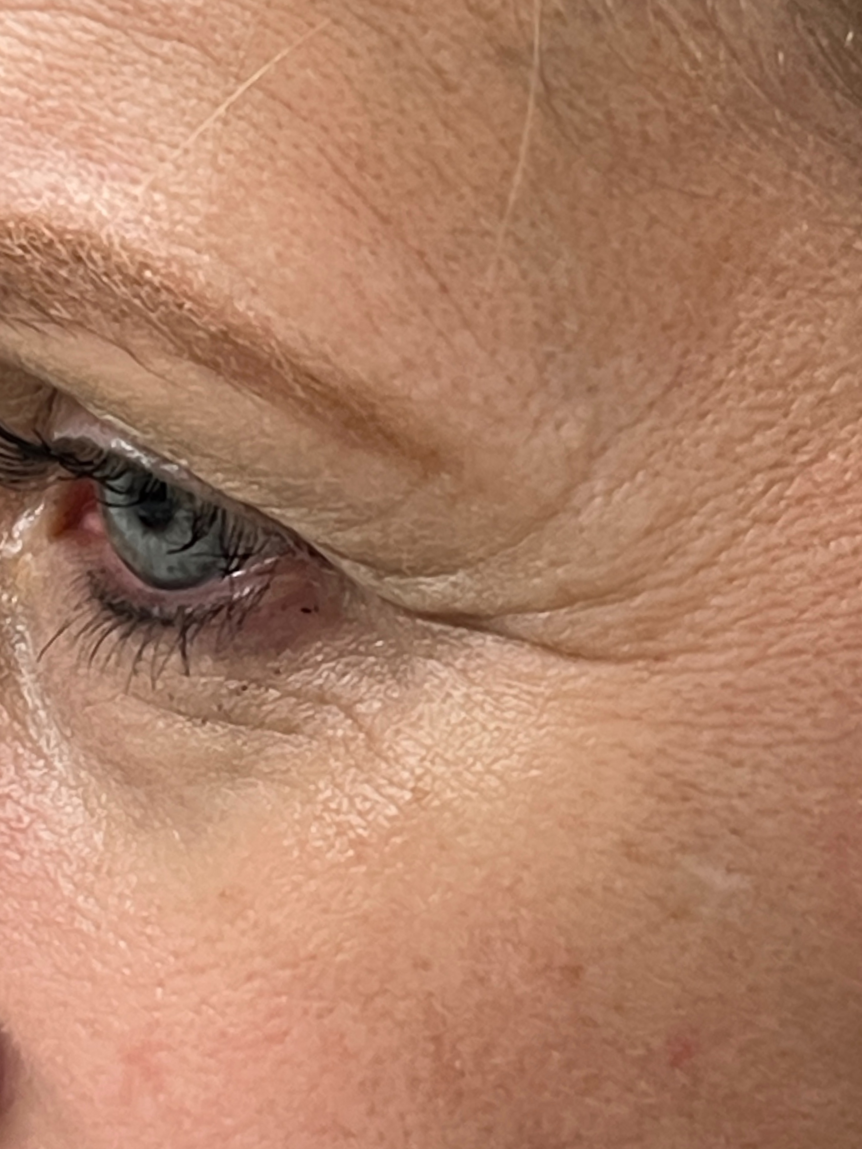 Vascular Laser Before and After | Rashid Plastic Surgery